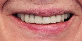 Cosmetic dentistry after treatment at Elm Ridge Implant and Family Dentistry in Killeen, TX